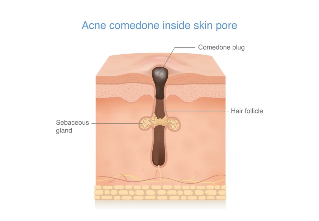 Schematische Darstellung eines verstopften Haarfollikels mit angesammeltem Talg und Keratin.